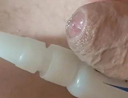 Homemade Self-adhesive Venous Pole Implant!!!