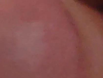 Immense Phimosis Being Extracted Cum and Précum.
