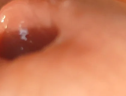 The Great Transformation of Phimosis Elastica.