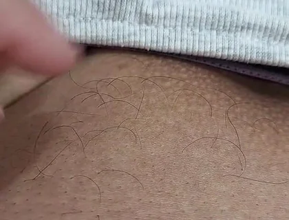 The Hair on My Penis - Led Hair Removal
