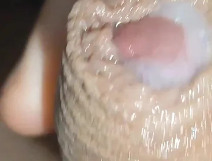 I Have the Largest Ejaculating Phimosis in the World!!