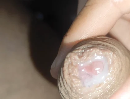 I Have the Largest Ejaculating Phimosis in the World!!