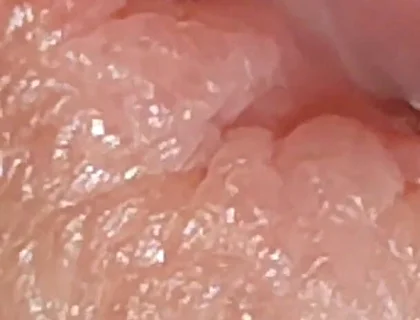 Enlargement of the Deep Urethral Hole!!