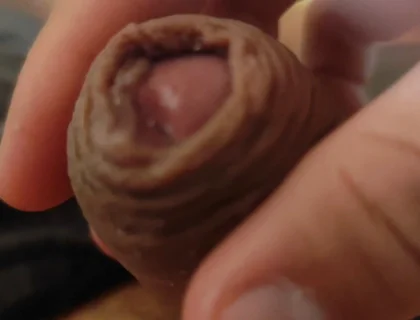 Great Phimosis Getting in the Way of the Boy's Orgasm