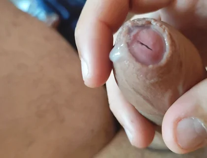 Dilation of the Corpus Cavernosum Exposes Spongy Foreskin.