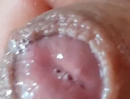 Deep Split in the Glans Produces Bubbling Liquid