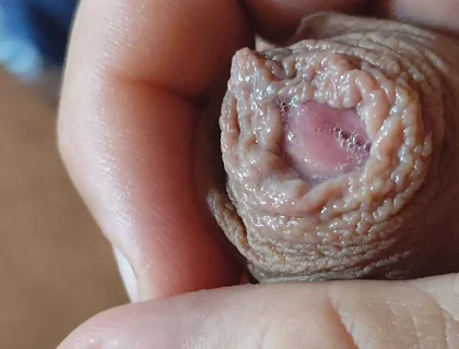 Deep Split in the Glans Produces Bubbling Liquid