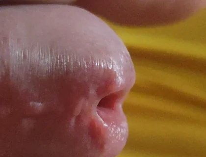 Scarred Frenulum Causes Glans Erection!