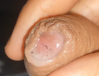 Curious Close-up of Pre-cum in Flaccid Phimosis.