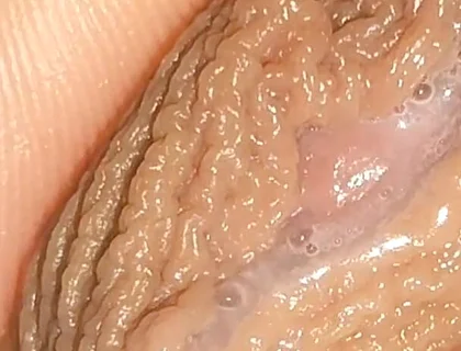 Curious Close-up of Pre-cum in Flaccid Phimosis.