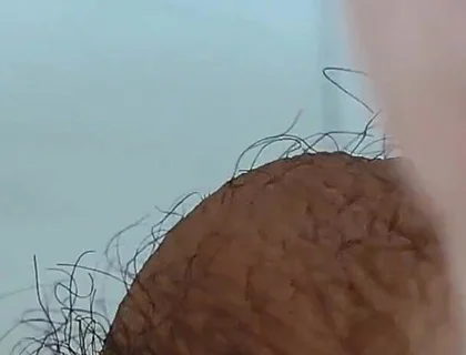 Extreme Open Hole Leaves the Glans Exposed.