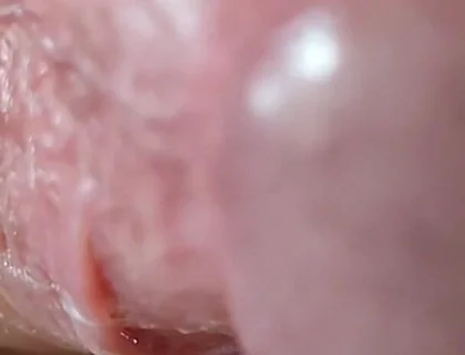Opening the Scar of the Rough Frenulum!