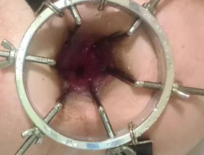 Enema, Anal Shower. Close-up View Through Anal Mirror. Anal with Water. Filling Anal with Water