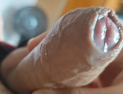 The Glans Appears Crowning Inside the Phimosis.