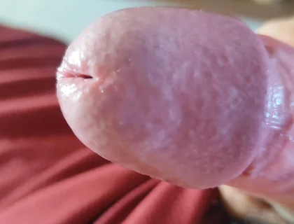 The Blossoming of Extensive Elastic Phimosis.
