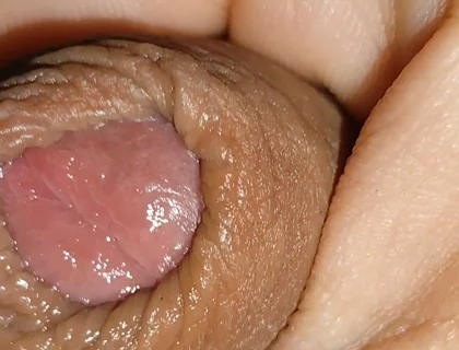 Boy with Large Anal Phimosis Excited!