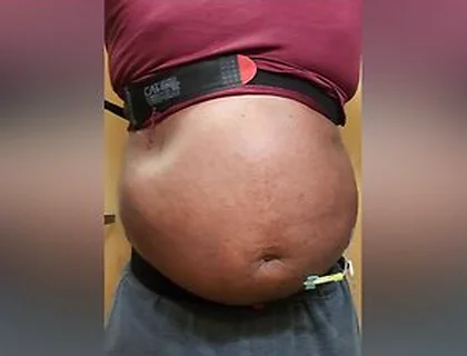 N2o Belly Inflation