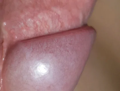 Amazing Upright Rough Venous Frenulum