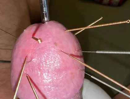 Acupuncture - Orgasm!