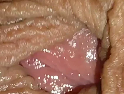 Boy with Large Anal Phimosis Excited!