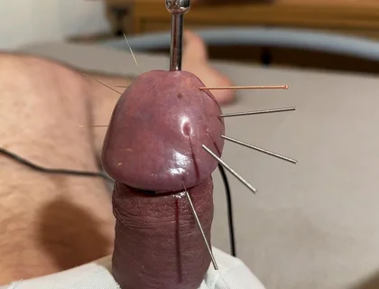 The Best Acupuncture Method!
