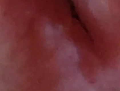Dilation of the Glans Eye Has a Pleasant Surprise.