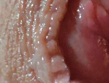 Dilation of the Glans Eye Has a Pleasant Surprise.