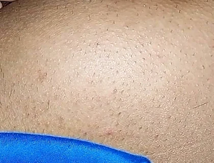 Hemorrhoids in the Ass