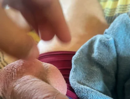 Extreme Venous Phimosis in the Pump!