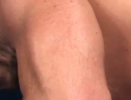 Rugburn