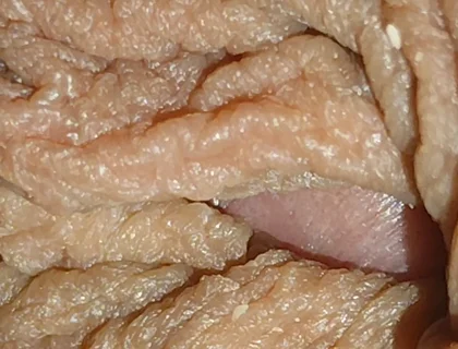 The World's Largest Foreskin Opening and Closing.