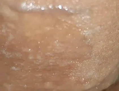 Scrotal Phimosis Results in an Extremely Hot Orgasm.